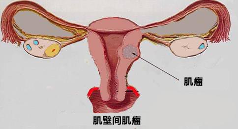 子宫肌瘤阻碍精子进入宫腔 构成不孕!